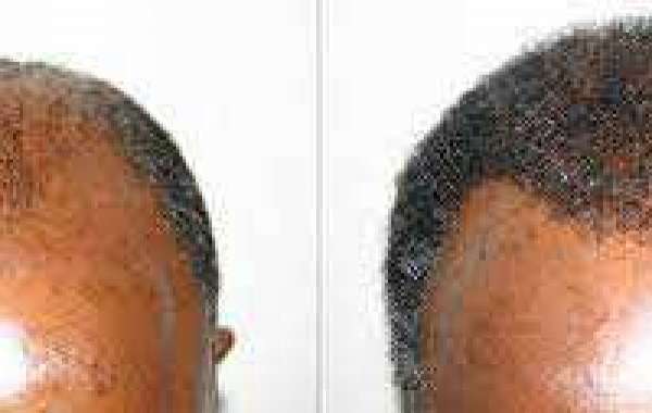 African American Hair Transplant Palm Desert